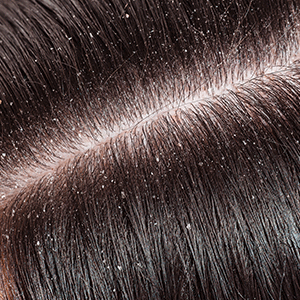 Dandruff & Dryness