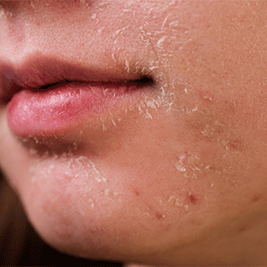 Dry skin or Dehydrated skin
