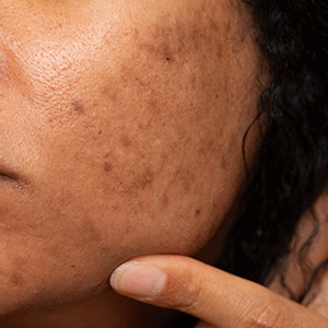 Pimple and Acne Free Collection