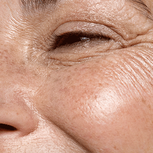 Ageing or Mature skin